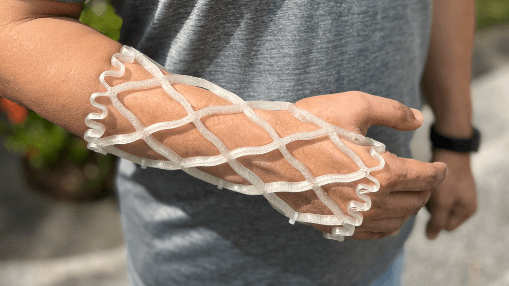 Castomize’s 4D printed orthopaedic cast